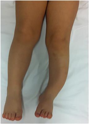 Anterolateral congenital tibial bowing: case report